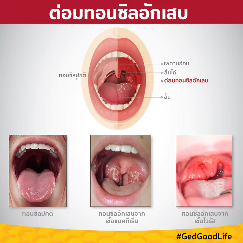 ต่อมทอนซิลอักเสบ