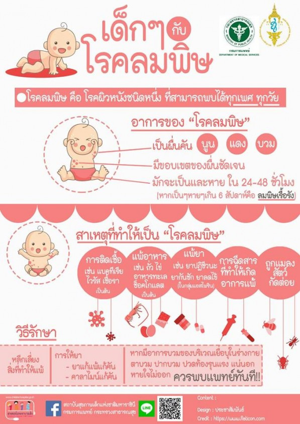 โรคลมพิษ