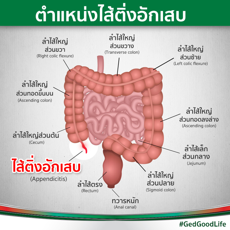 ไส้ติ่งอักเสบ