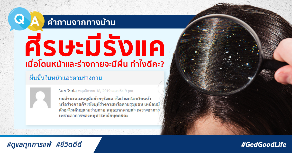 ศีรษะมีรังแค เมื่อโดนหน้าและร่างกายจะขึ้นผื่น ทำไงดี? | Ged Good Life ชีวิตดีดี ศีรษะมีรังแค เมื่อโดนหน้าและร่างกายจะขึ้นผื่น ทำไงดี? | Ged Good Life ชีวิตดีดี