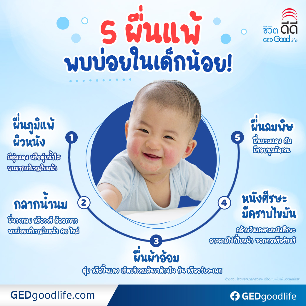 โรคผื่นภูมิแพ้ผิวหนังในเด็ก