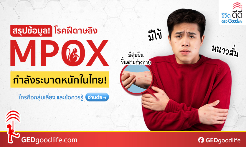 โรคฝีดาษ Mpox